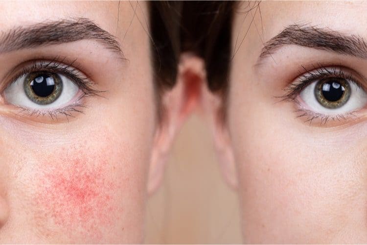 How To Get Rid Of Redness From Crying